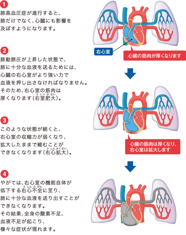 肺高血圧症による肺と心臓への影響の解説図