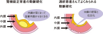 透析患者さんの動脈硬化の特徴は、血管の石灰化 透析患者さんの動脈硬化の特徴は、血管の石灰化