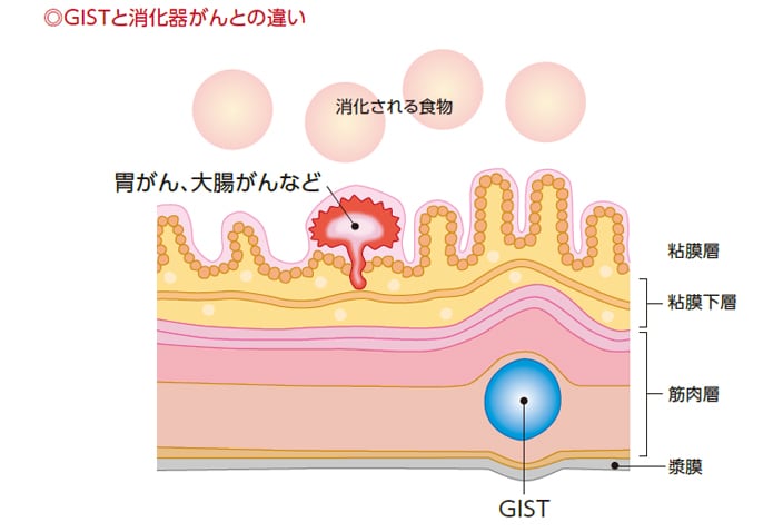 GISTと消化器がんの違い