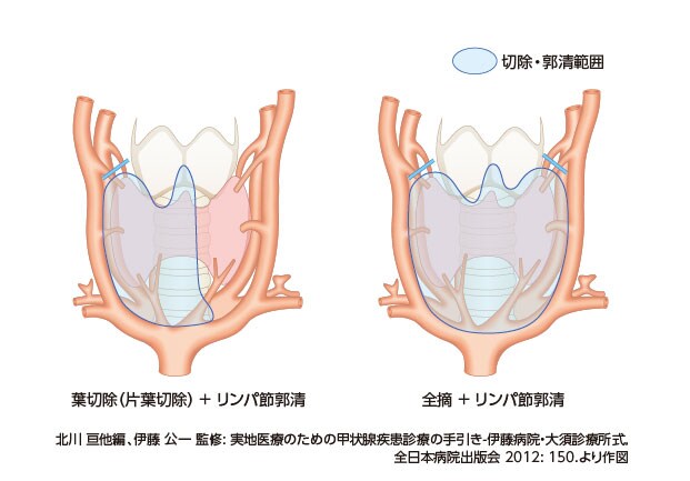 図8.甲状腺がんの手術範囲 図8.甲状腺がんの手術範囲