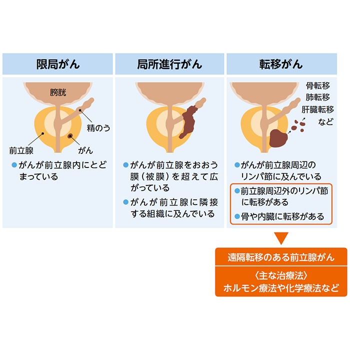 前立腺がんの遠隔転移について